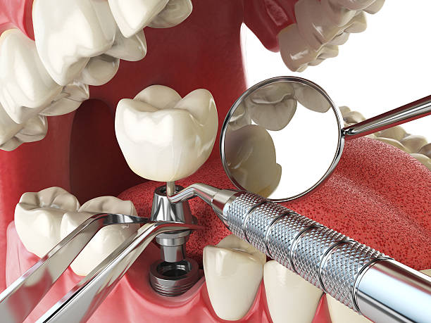 Best Emergency Dental Care for Abscessed Tooth in Granite Falls, NC